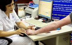 Viêm da cơ địa hoành hành mùa lạnh